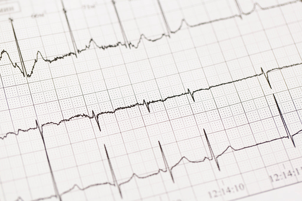 Close-up of an electrocardiogram (ECG) printout displaying heart electrical activity as a series of wave patterns on graph paper.